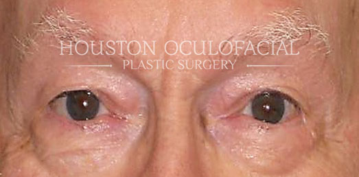 Eyelid Skin Cancer - After Houston