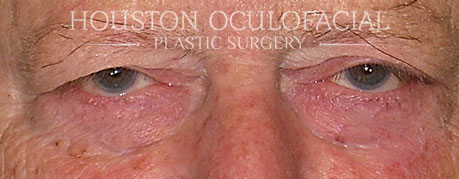 Eyelid Skin Cancer - After Houston