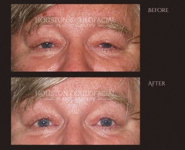 Ptosis: The Medical Term for Drooping Eyelid - Sami, Mirwat ...