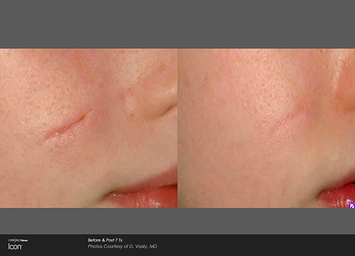 Houston Surgical Scar Removal