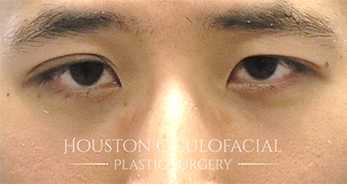 double eyelid surgery houston