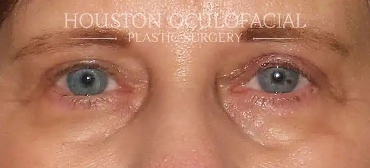 Before and After Ptosis Ptosis Blepharoplasty - After